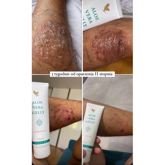 efekty stosowania Aloe Vera Gelly